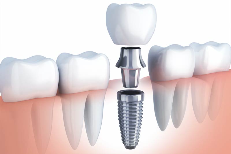 Dental Implants in Brighton