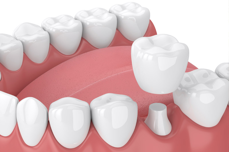 Dental Crowns in Brighton