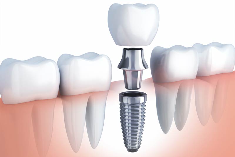 Implants Dentist in Brighton
