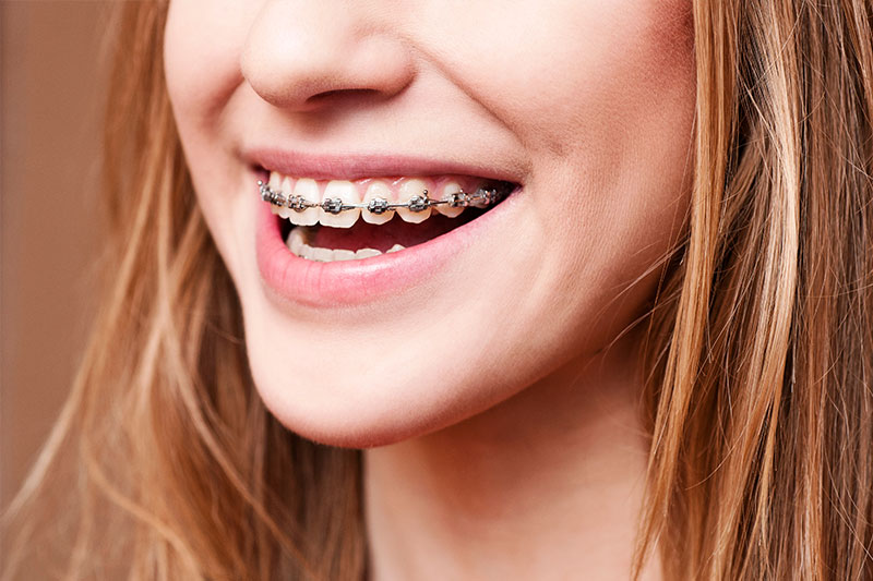 Orthodontics in Brighton